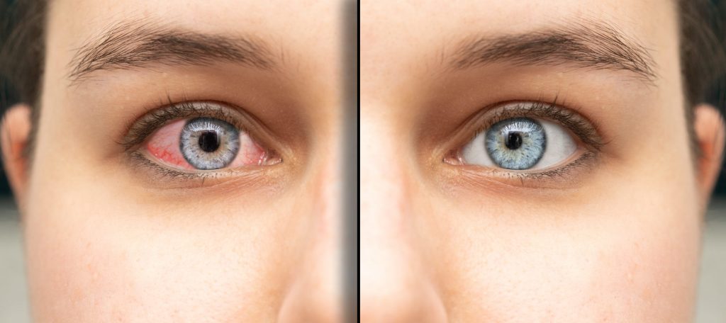 Global Conjunctivitis Treatment Market