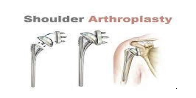 Global Shoulder Arthroplasty Market Research, Global Shoulder Arthroplasty Market Volume