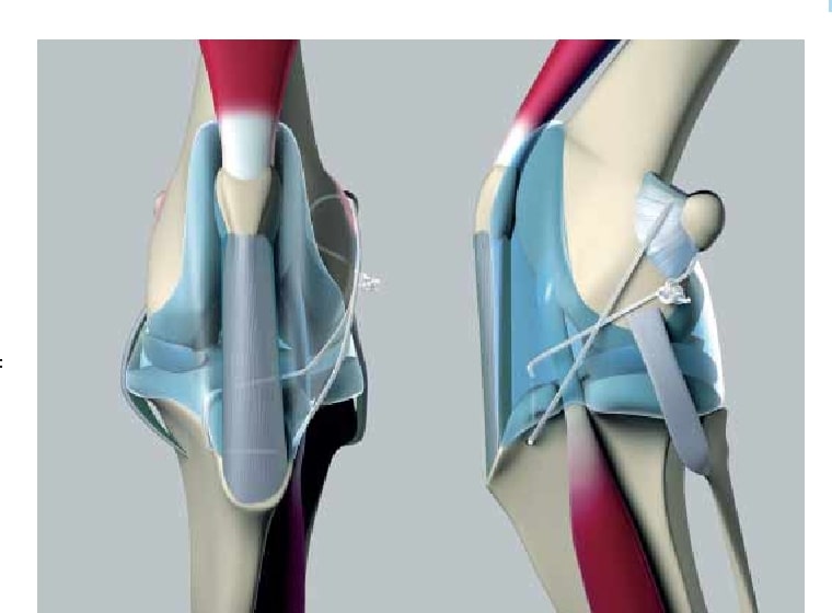 Global Articular Prostheses Market