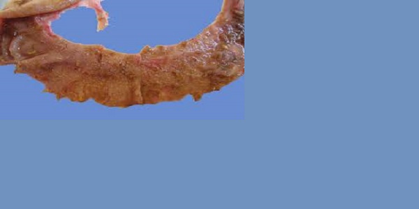 Global Necrotic Enteritis Drug Market Is Predicted To Develop Owing To Growing Health Awareness: Ken Research