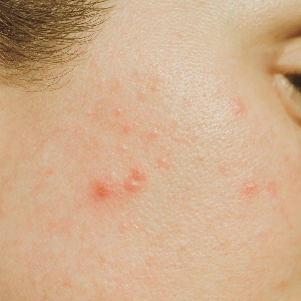 Global Acne Medication Market