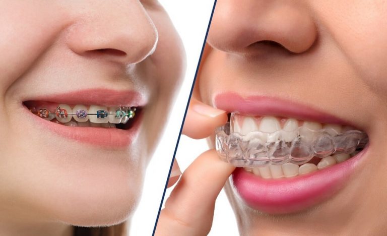 Global Orthodontics Dental Consumables Market