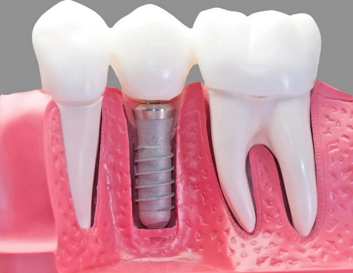 Global-Single-Tooth-Implants-and-Dental-Bridges-Market