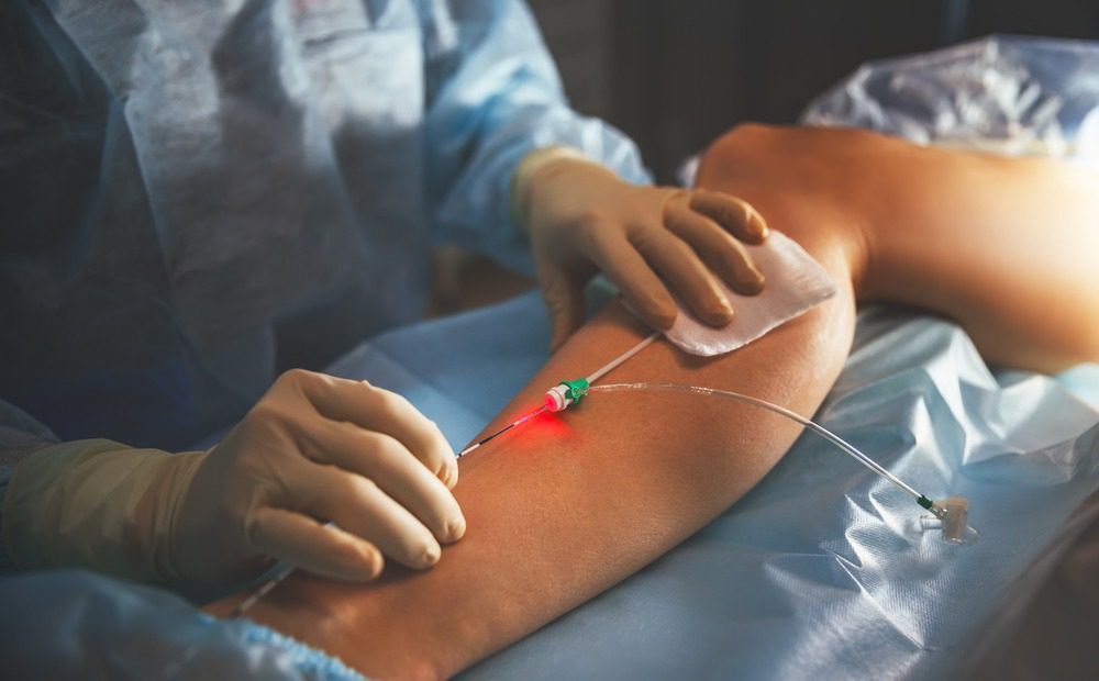 Varicose Vein Treatment Market