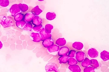 US Acute Myeloid Leukemia Market
