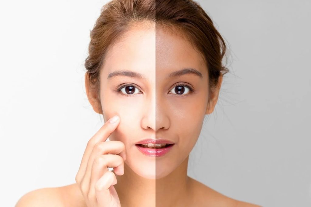 Skin Whitening Market